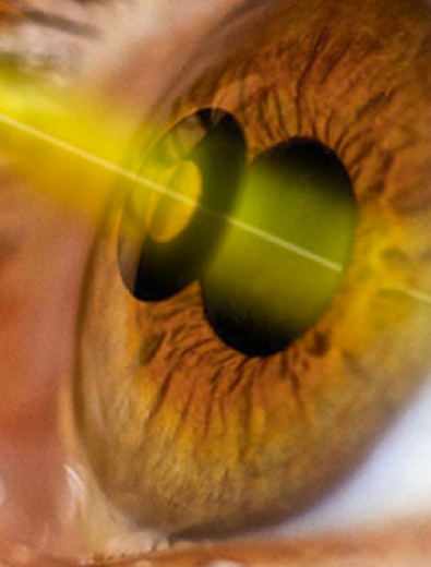 Fototrabeculoplastia e Iridectomia (Cirurgia de Glaucoma a Laser) thumbnail