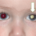 Olho de criança com retinoblastoma mostrando reflexo branco na pupila