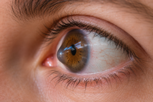 Olho humano em close-up com córnea em formato cônico, característica do ceratocone, destacando a alteração na curvatura corneana que pode causar distorção visual e redução da qualidade da visão.